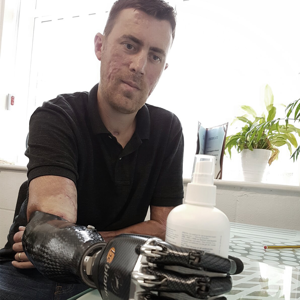Dad Receives State-of-the-Art Bionic Hand