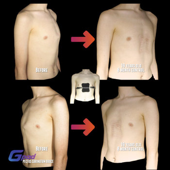 Pectus Carinatum Chest Brace Before And After 8 Months