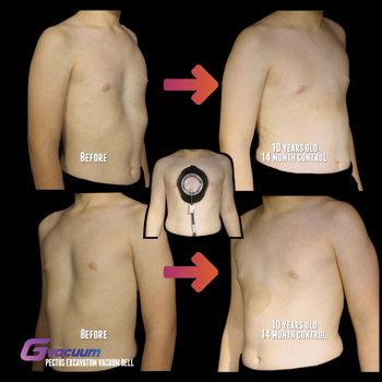 Pectuslabs Vacuum Bell Pectus Excavatum Treatment Before And After