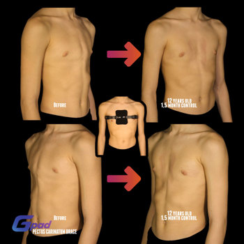 Pectus Carinatum Chest Brace Before And After 1.5 Months Pectus Carinatum Chest Brace Before And After 1.5 Months