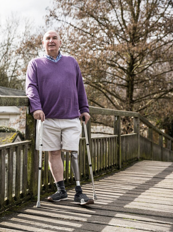 Common Issues with Prosthetic Devices An old man using crutches whilst leaning on a bridge with an above knee amputation lower left limb prosthetic device
