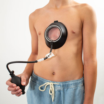 Pectus Excavatum Bell In Use Pectus Excavatum Bell In Use