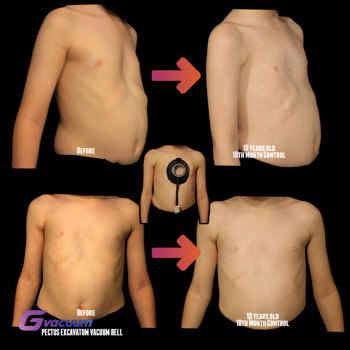 Pectuslabs Vacuum Bell Pectus Excavatum Treatment Before And After 10Months Pectuslabs Vacuum Bell Pectus Excavatum Treatment Before And After 10Months