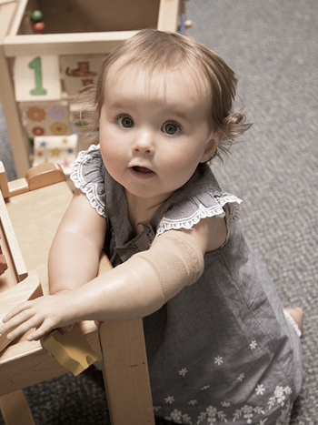 Toddler Paediatric Prosthetics A toddler with a prosthetic left arm leaning on a table playing with a wooden puzzle